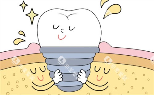 种植牙卡通展示图片 种植牙卡通展示图片