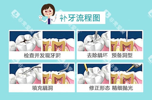 补牙流程图示