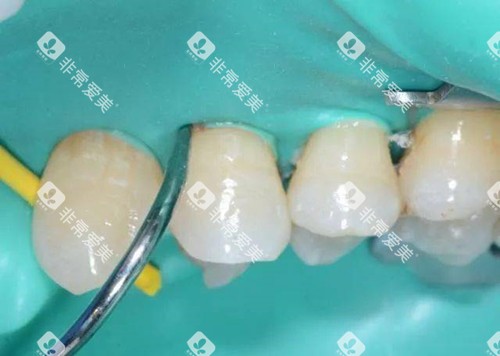 橡皮障在补牙中的运用