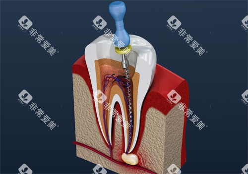 根管治疗中的牙齿