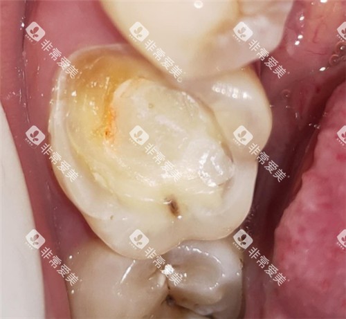 牙齿龋坏清理图