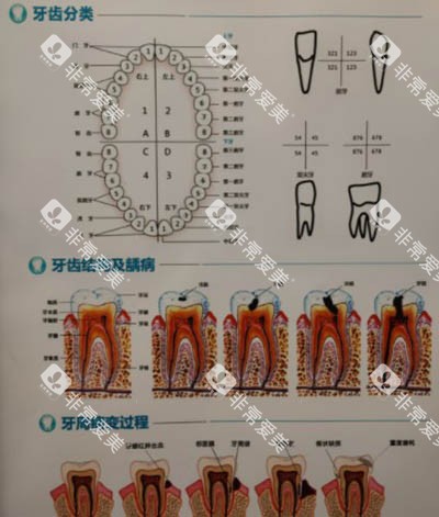 牙齿龋坏发展过程图