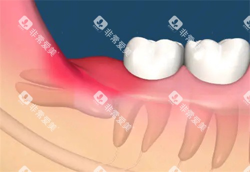 智齿发炎动画图