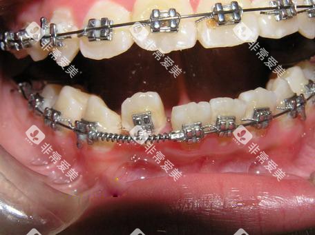 牙齿矫正正畸推簧口内展示图