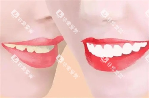 牙齿美白前后对比图