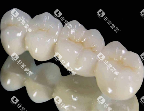 钯金烤瓷牙模型