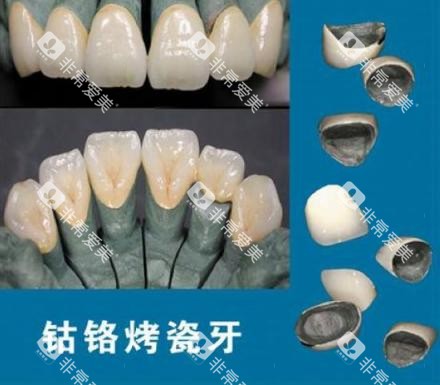 钴铬合金烤瓷牙示意图