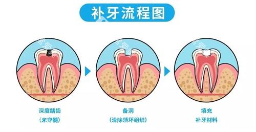 补牙的流程