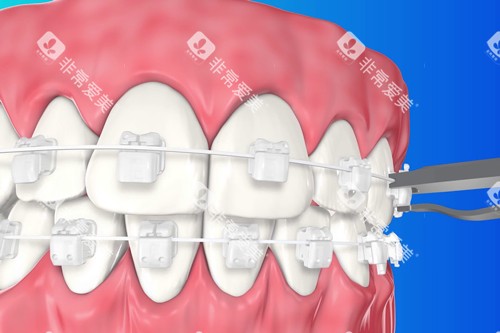 3M自锁托槽牙套示意图 3M自锁托槽牙套示意图