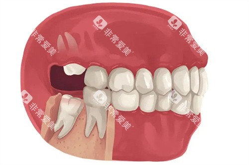 上下智齿萌出 上下智齿萌出