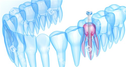 牙齿内部根管透视图 牙齿内部根管透视图