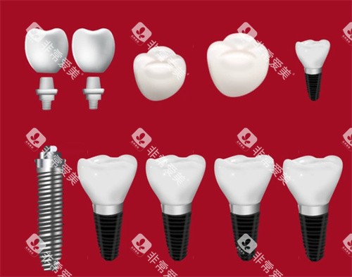 种植牙种植体牙冠 种植牙种植体牙冠