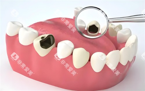 蛀牙动画展示图片