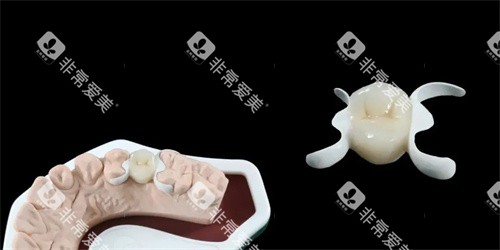 hpp粘接桥义齿实物展示图