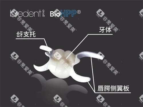 hpp粘接桥结构展示图