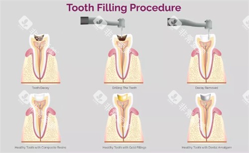 补牙过程图 补牙过程图