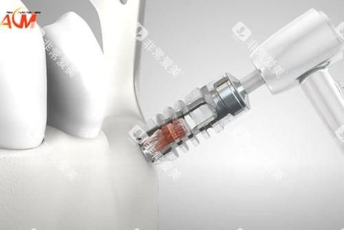 德国ACM种植牙示意图