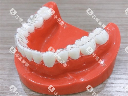 牙齿矫正隐形牙套模型图 牙齿矫正隐形牙套模型图