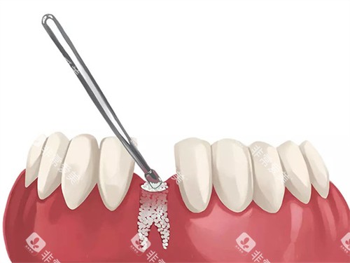 种植牙植骨的漫画图 种植牙植骨的漫画图