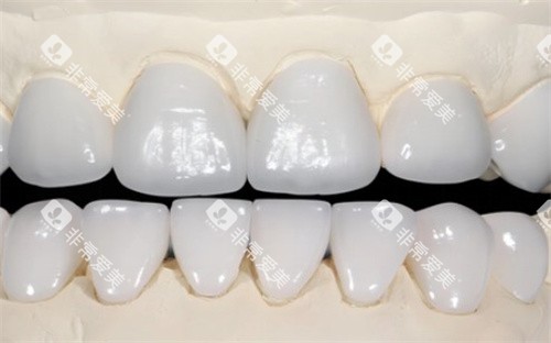 全口全瓷牙 全口全瓷牙