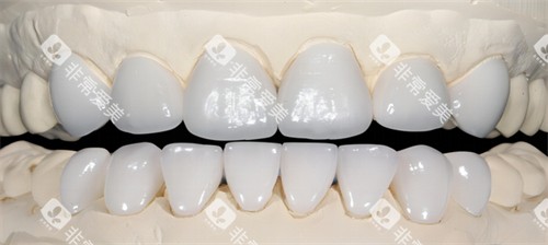 全瓷牙的光泽和颜色 全瓷牙的光泽和颜色