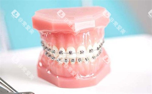 金属自锁牙套 金属自锁牙套