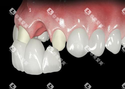 前牙全瓷牙展示 前牙全瓷牙展示