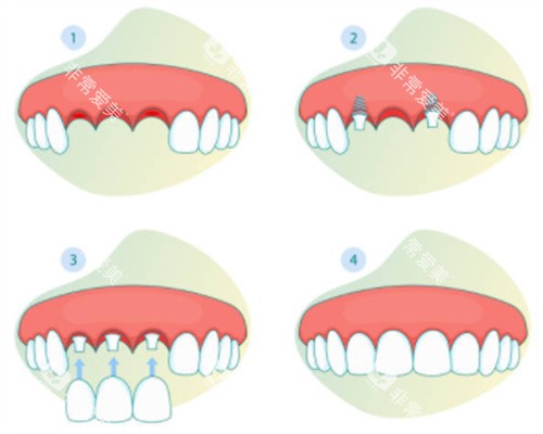 门牙缺失三颗示意图 门牙缺失三颗示意图