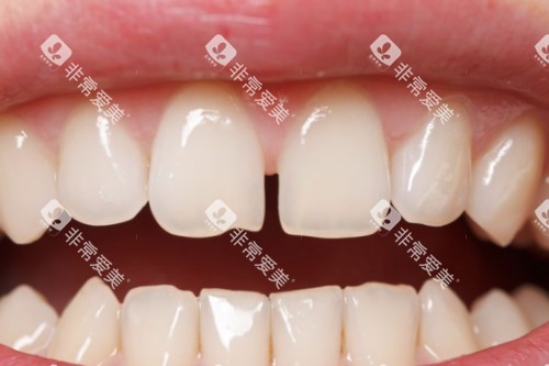 门牙牙缝大模型图 门牙牙缝大模型图