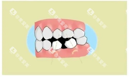 门牙歪斜结构示意图 门牙歪斜结构示意图