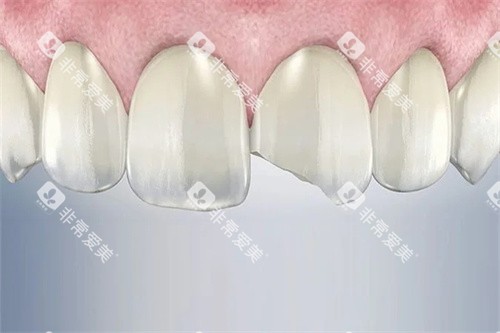 断裂的门牙图 断裂的门牙图