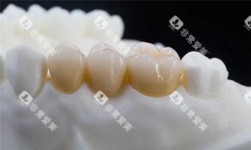 全瓷牙冠图