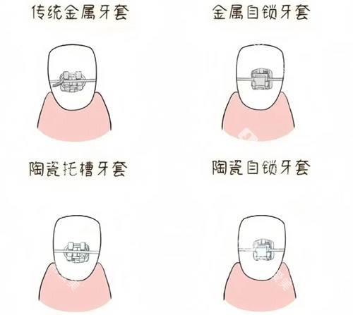 牙套品牌种类示意图 牙套品牌种类示意图