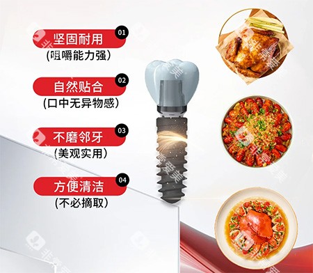 安特种植牙特色优点 安特种植牙特色优点