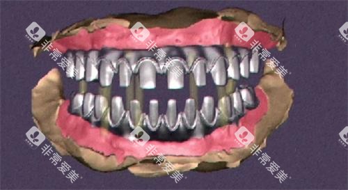 全口马龙桥架示意图 全口马龙桥架示意图