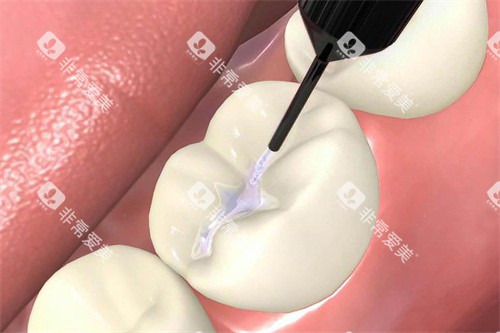 窝沟封闭剂涂抹