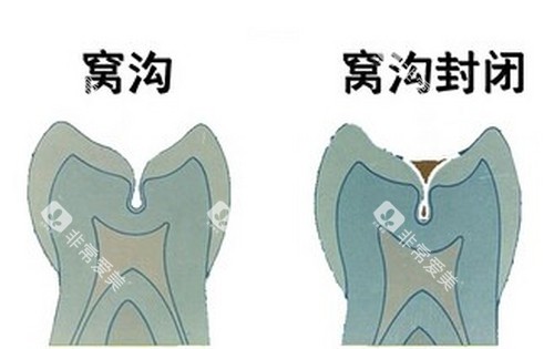 窝沟及窝沟封闭示意图