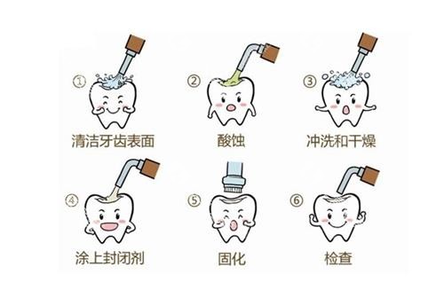 窝沟封闭流程图