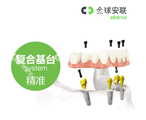 安联种植牙复合基台照片 安联种植牙复合基台照片