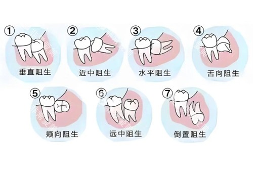 智齿难度系数图