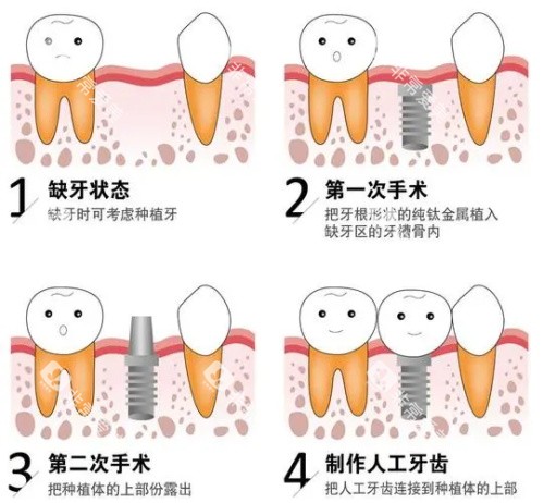 种植牙后的成效