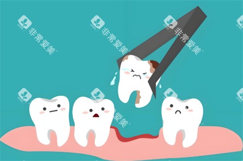 拔牙动画示图