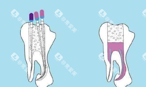 根管治疗手术示意图