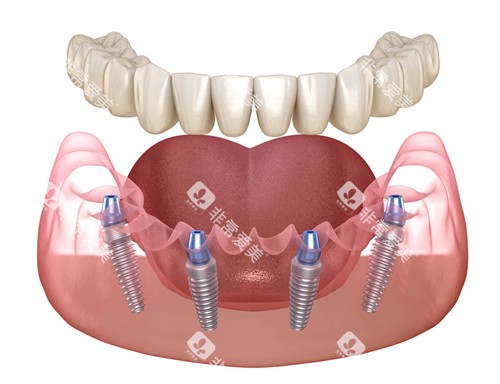半口种植牙动画图示