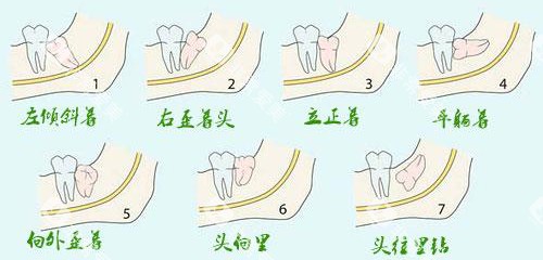 不同类型的智齿示意图