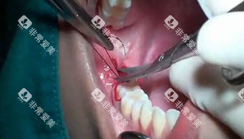 拔智齿手术细节图