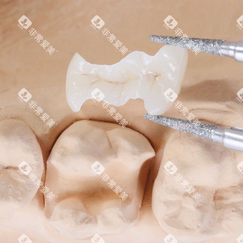 补牙嵌体展示