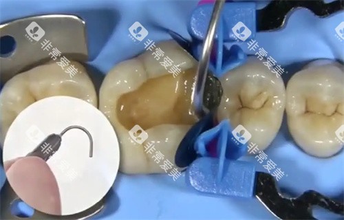 龋坏牙治疗 龋坏牙治疗