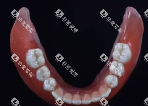 吸附性全口义齿
