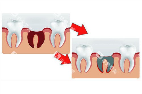 正常牙窝和干槽症牙窝对比 正常牙窝和干槽症牙窝对比